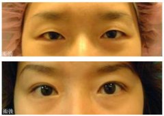 大小眼手术价格详解,你想知道的所有信息都在这里!