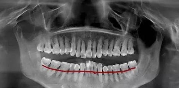最新牙龈再生技术,重塑自信灿烂笑容的秘诀