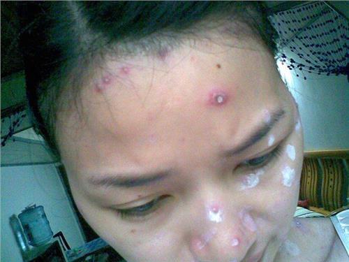 最新点痣技术一擦即除——科技助力瞬间重塑肌肤之美