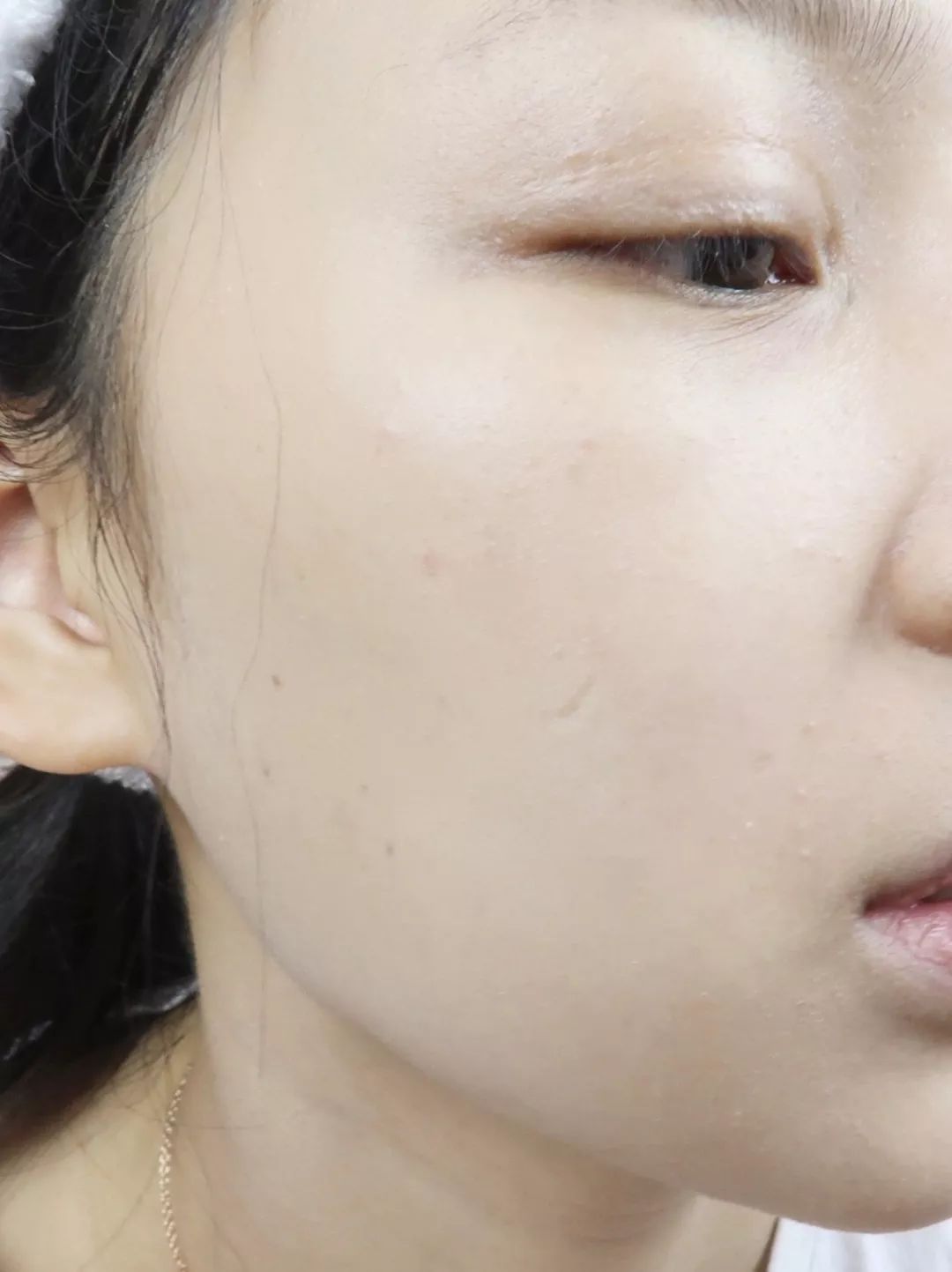 最新点痣技术一擦即除——科技助力瞬间重塑肌肤之美