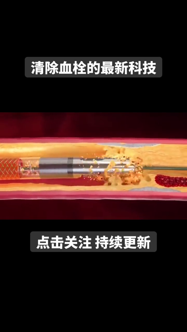 最新血栓设备论述及其应用概述