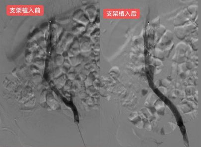 最新血栓设备论述及其应用概述